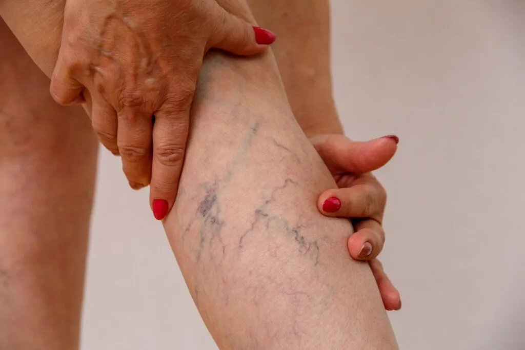 Recognizing the Symptoms and Treatment Options for Varicose Veins