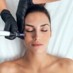 Addressing FAQs About Microneedling