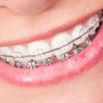 Comparing Clear Braces to Traditional Braces for Orthodontic Success