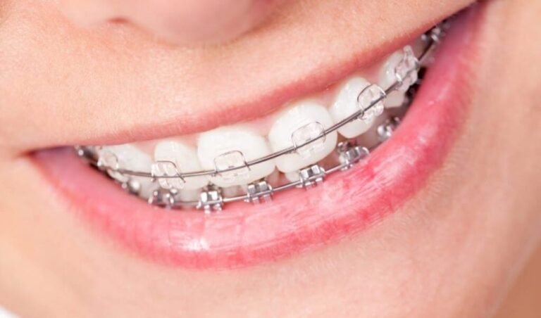 Comparing Clear Braces to Traditional Braces for Orthodontic Success