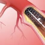 Exploring the Benefits of Cardiac Catheterization in Diagnosing Heart Conditions