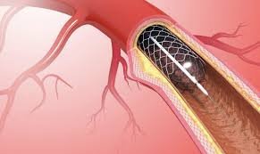 Exploring the Benefits of Cardiac Catheterization in Diagnosing Heart Conditions