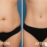 Exploring the Benefits of Liposuction for Body Contouring