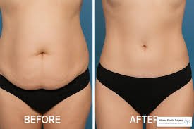 Exploring the Benefits of Liposuction for Body Contouring