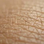 Exploring the Benefits of Mohs Micrographic Surgery for Skin Cancer Treatment