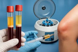 Exploring the Benefits of Stem Cell Therapy for Degenerative Disc Disease