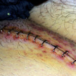 Helpful Things To Know About Hernia Surgery