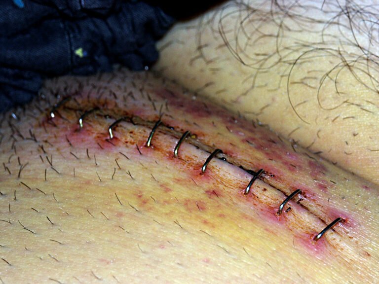 Helpful Things To Know About Hernia Surgery