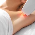 How Laser Hair Removal Works