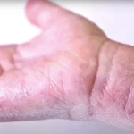 How to Build a Skincare Routine for Eczema