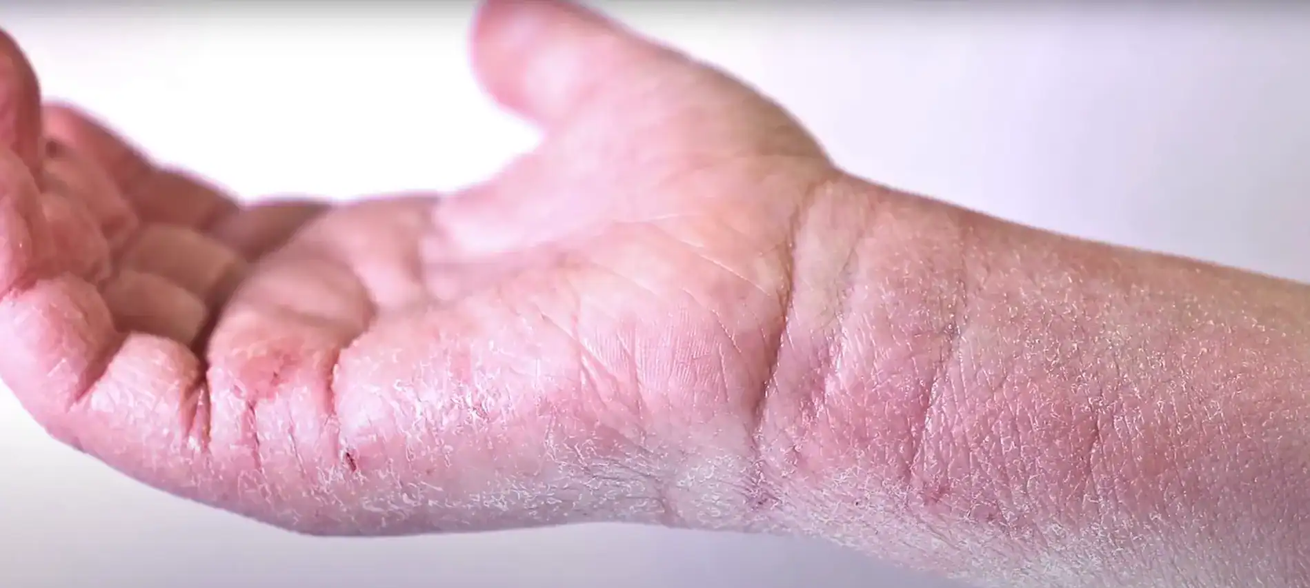 How to Build a Skincare Routine for Eczema