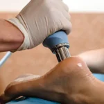 Innovative Treatments for Plantar Fasciitis