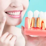 Long-Term Benefits of Choosing Dental Implants