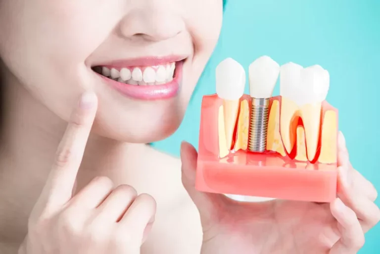 Long-Term Benefits of Choosing Dental Implants