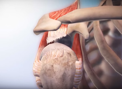 Recovery Process After a Rotator Cuff Tear