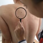Signs To Look for When Detecting Skin Cancer Early