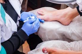 Steps for Ingrown Toenail Prevention