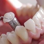 The Financial Aspects of Dental Implants: What to Expect