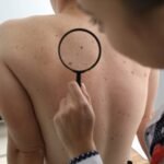 The Importance of Regular Exams for Identifying Problematic Moles