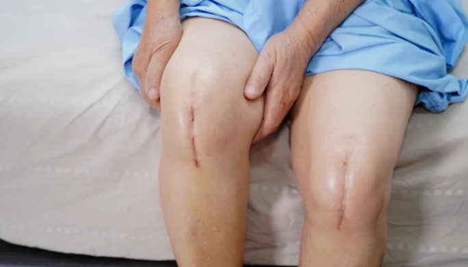 The Role of Joint Replacement in Restoring Functionality