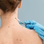 Understanding the Different Types of Skin Cancer