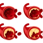 Understanding the Effects of Vascular Disorders on Quality of Life