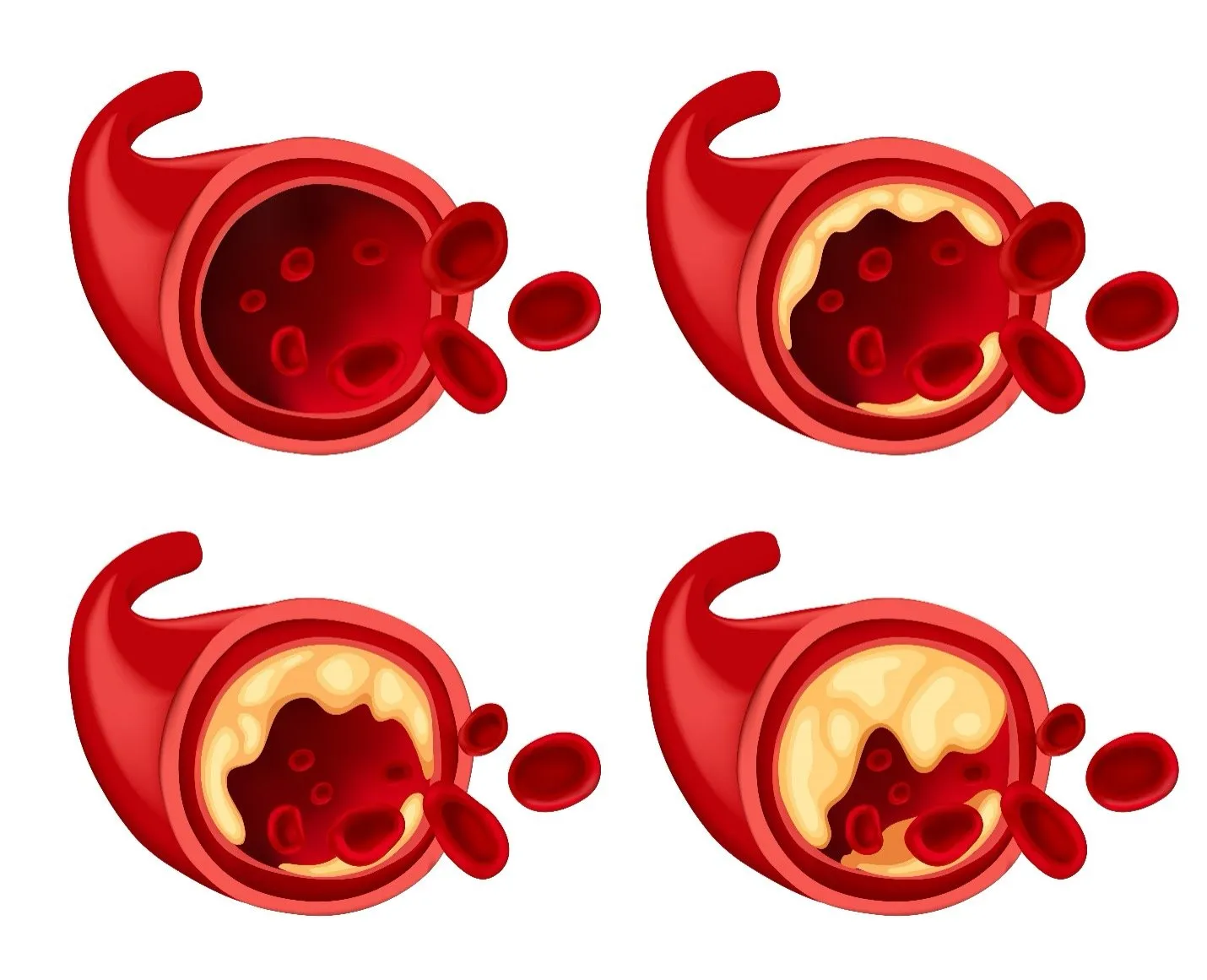 Understanding the Effects of Vascular Disorders on Quality of Life
