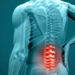 What Patients Should Know About Spine Surgery for Scoliosis