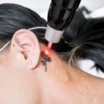 What To Know About Tattoo Removal and Skin Health