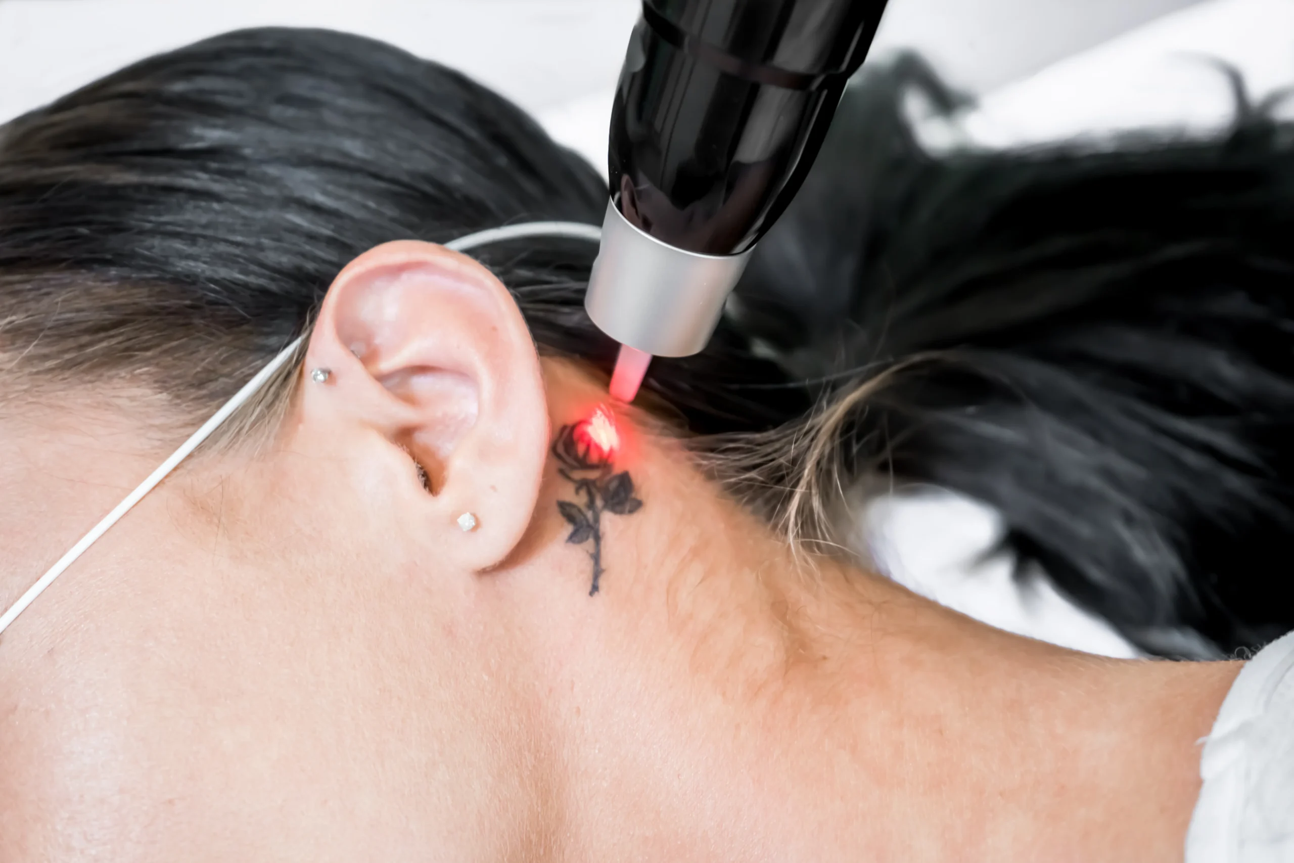 What To Know About Tattoo Removal and Skin Health