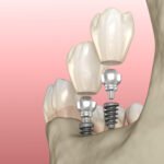 Choosing The Right Endodontic Implants For Your Dental Needs
