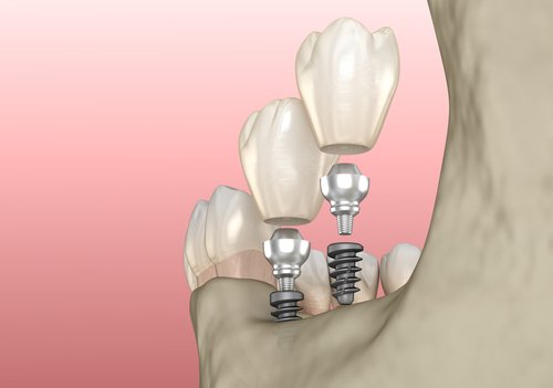 Choosing The Right Endodontic Implants For Your Dental Needs