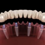 Comparing All-On-4 and All-On-6 Restorations