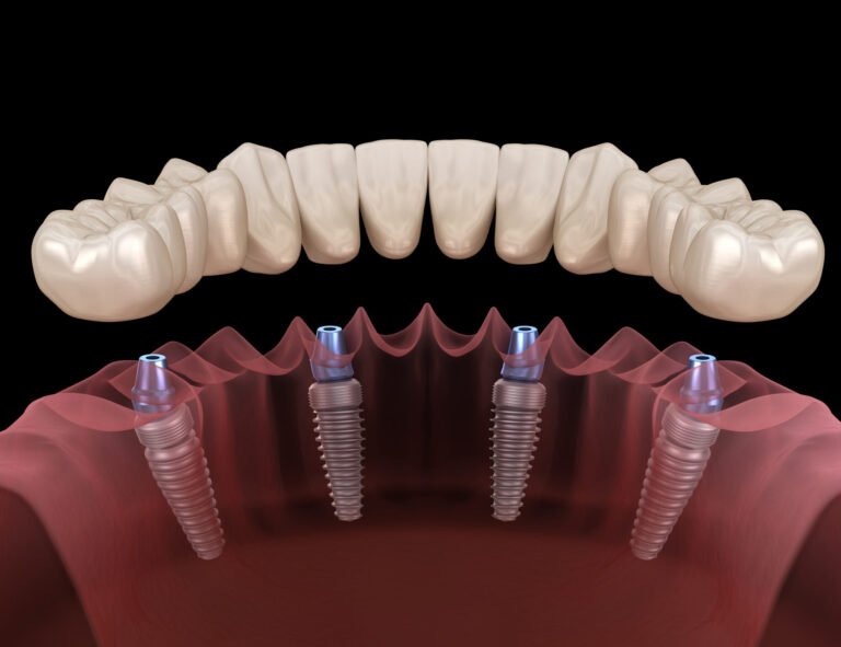 Comparing All-On-4 and All-On-6 Restorations