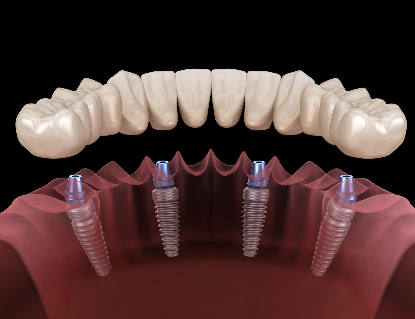 Comparing All-On-4 and All-On-6 Restorations