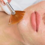 Do Dermatologist Recommend Chemical Peels or Microdermabrasion?