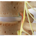 Epidural Injections for Sciatica Pain