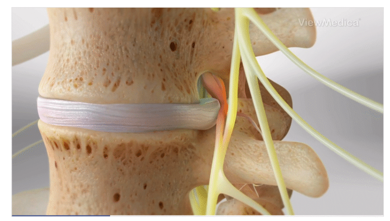 Epidural Injections for Sciatica Pain