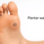 How Plantar Warts Develop and How To Treat Them