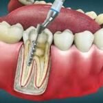 How an Endodontist Can Save Your Natural Teeth