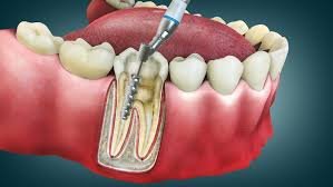 How an Endodontist Can Save Your Natural Teeth