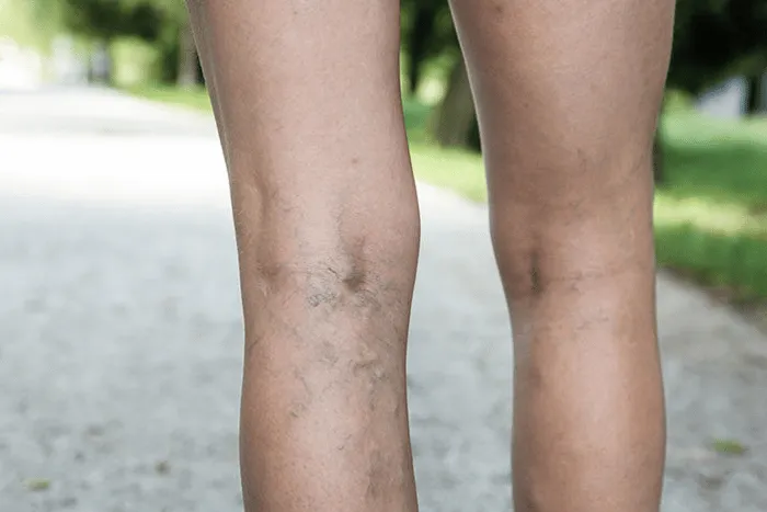 Lifestyle Changes for Better Vein Health