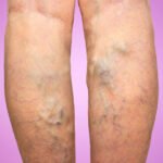 Lifestyle Changes to Prevent Varicose Veins