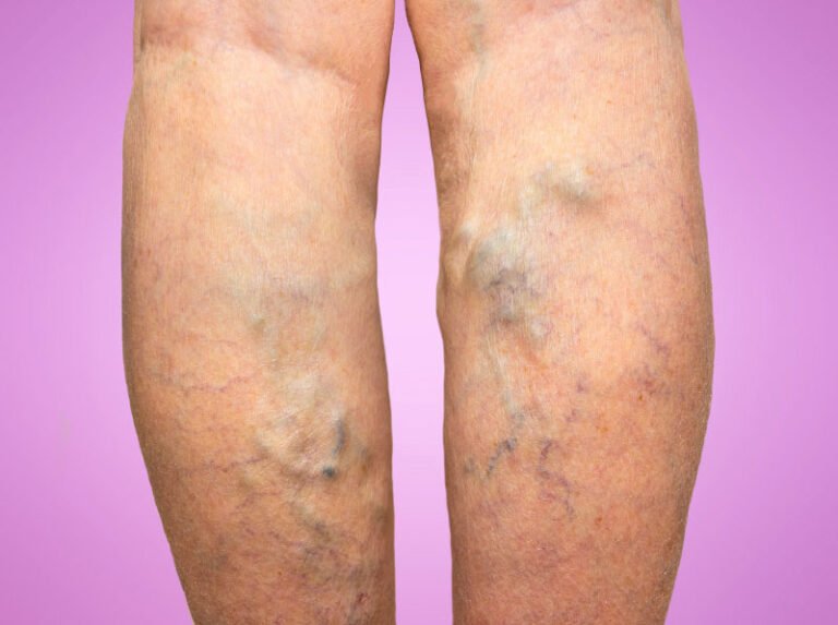 Lifestyle Changes to Prevent Varicose Veins