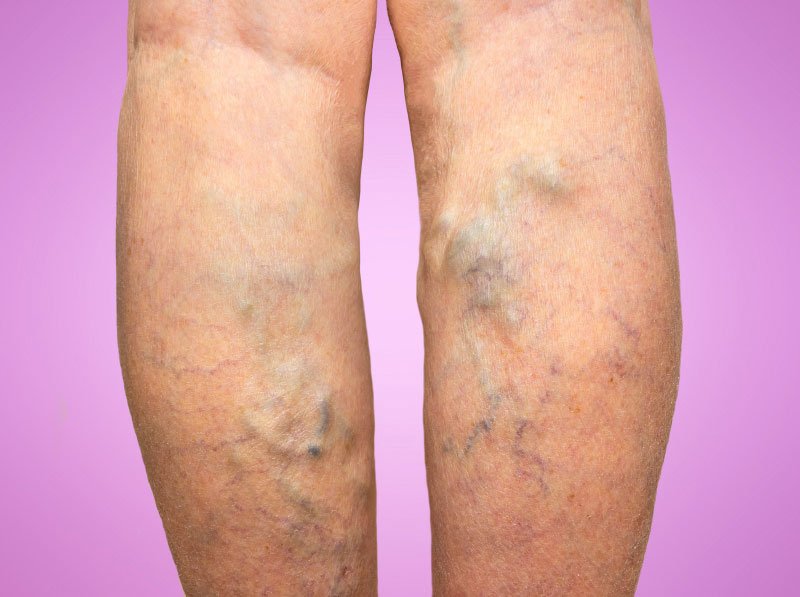 Lifestyle Changes to Prevent Varicose Veins