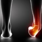 Recognizing the Symptoms of a Fractured Ankle