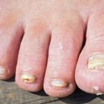 Remedies for Foot Fungus