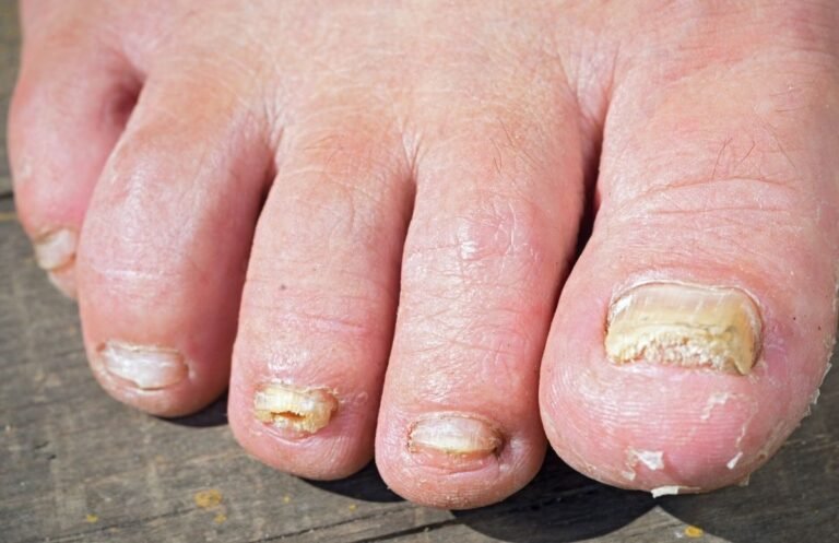 Remedies for Foot Fungus