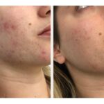 The Benefits of SkinPen Microneedling for Acne Scarring