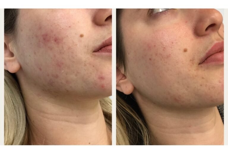 The Benefits of SkinPen Microneedling for Acne Scarring